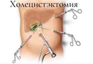 Холецистэктомия Холецистэктомия