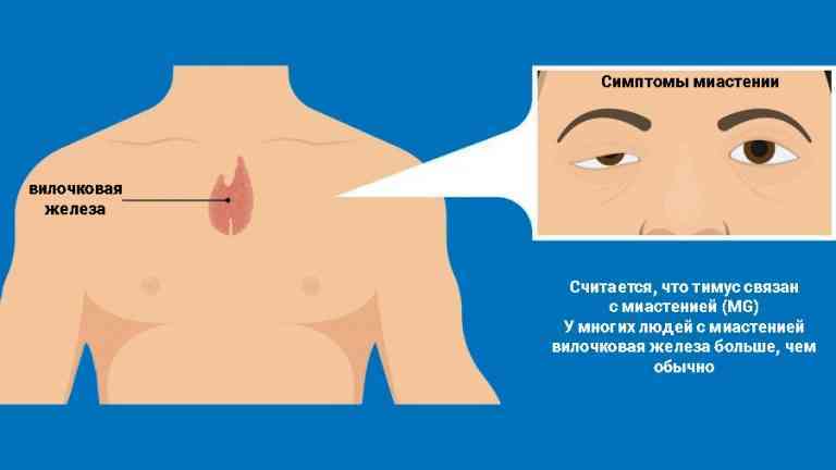 Миастения - симптомы, лечение, причины заболевания.