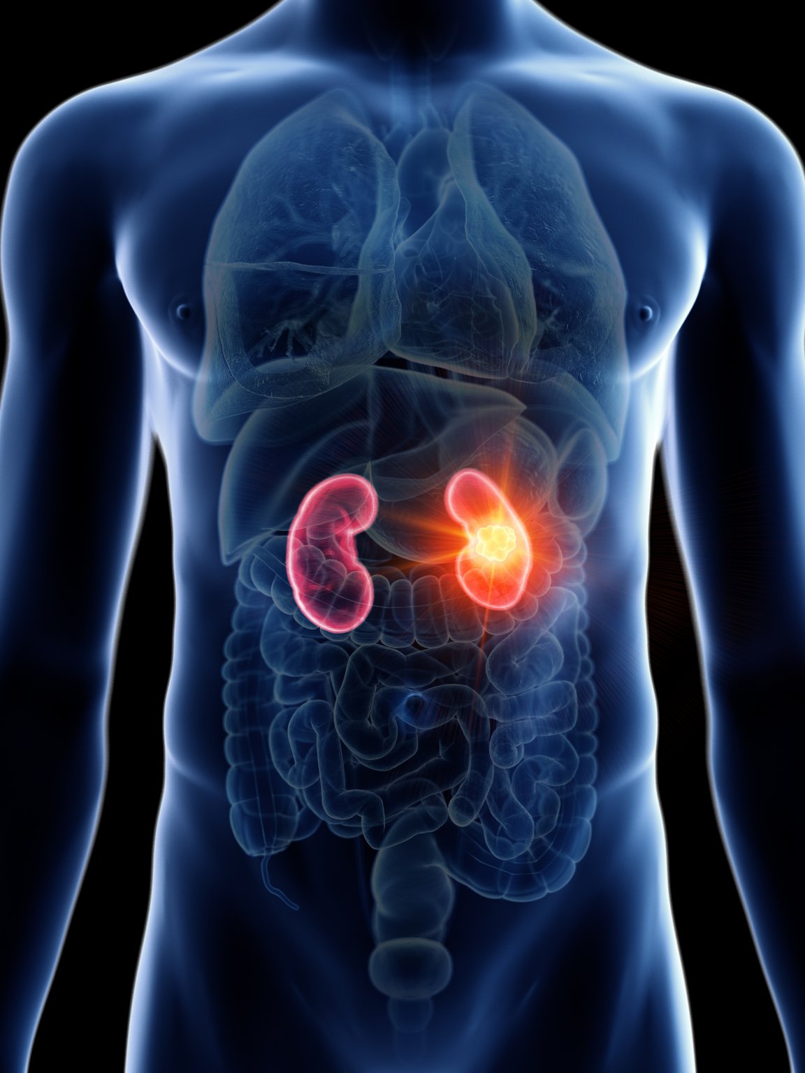 Мочекаменная болезнь - симптомы, признаки, лечение МКБ у мужчин и женщин