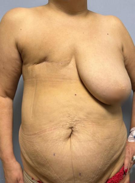 Реконструкция молочной железы DIEP лоскутом