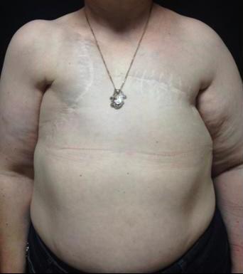 Лимфедема (лимфостаз)