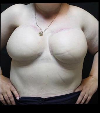 Лимфедема (лимфостаз)