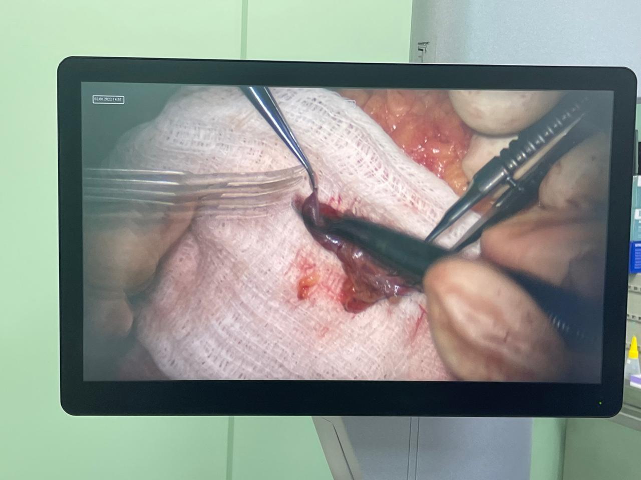 Операция по восстановлению объема молочной железы