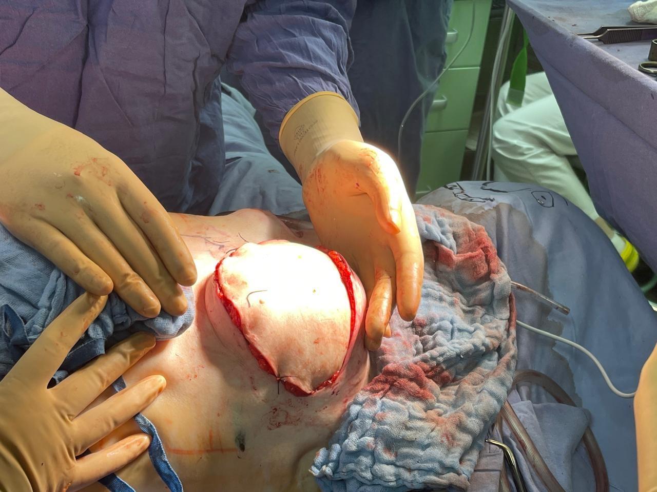 Реконструкция молочной железы одномоментная отсроченная с использованием аутологичного лоскута