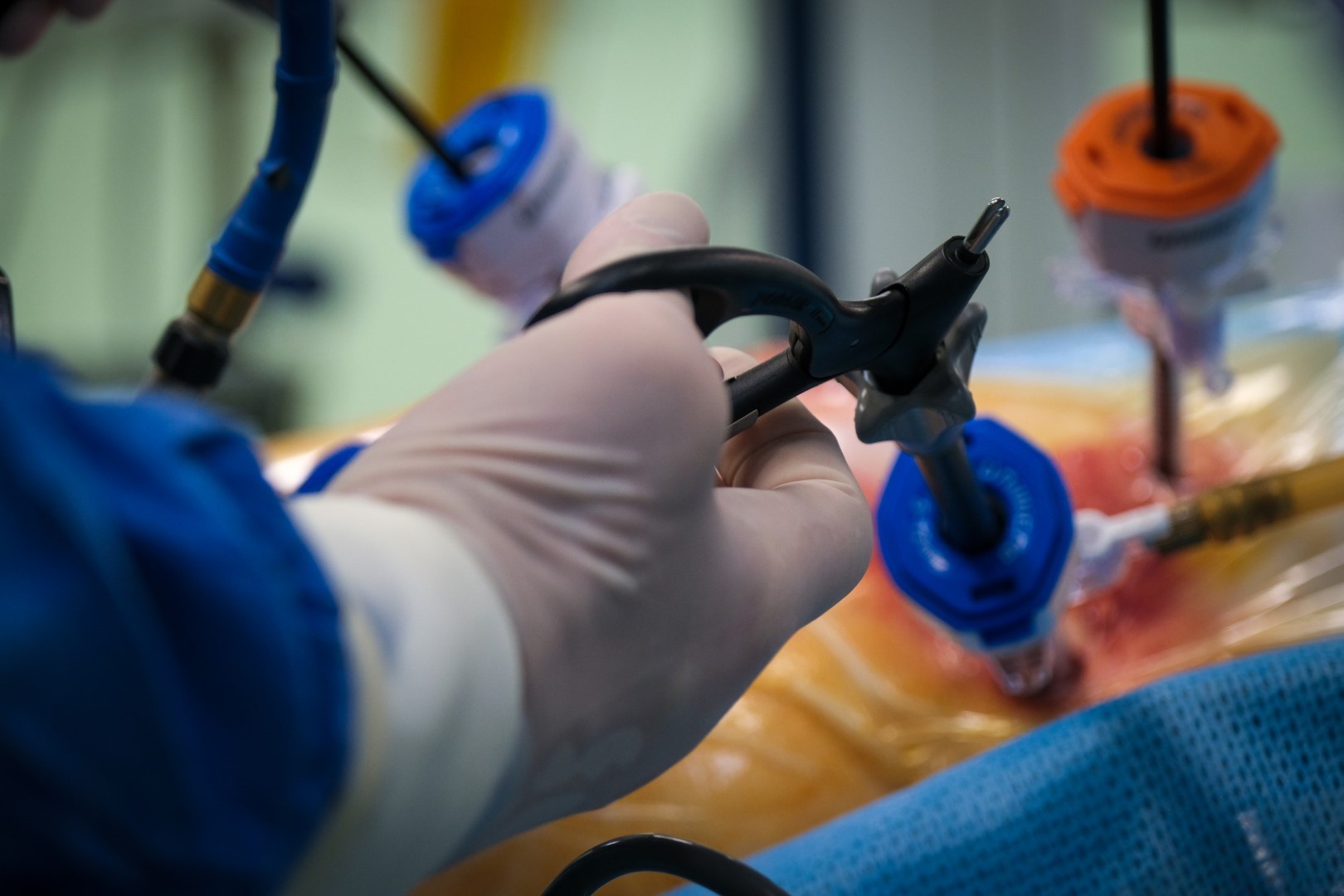 резекция верхней части желудка