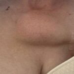 THE USE OF CUSTOMIZED TITANIUM ENDOPROSTHESES HELPS TO RESTORE THORACIC FUNCTION AFTER EXTENSIVE SURGERIES