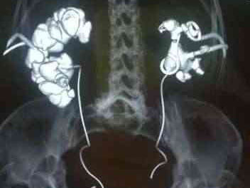 диагностика и лечение камней в почках (КОПИЯ)