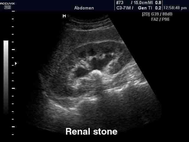 диагностика мочекаенной болезни конкременты (КОПИЯ)