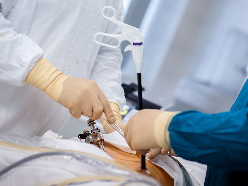 лапароскопическая операция на предстательной железе