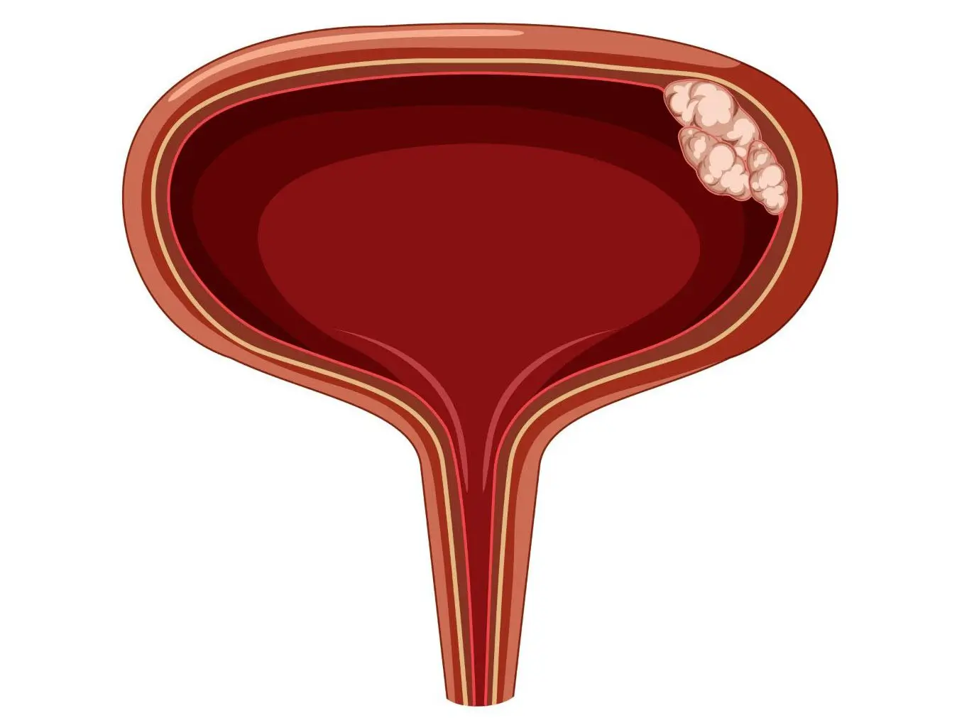 опухоль мочевого пузыря