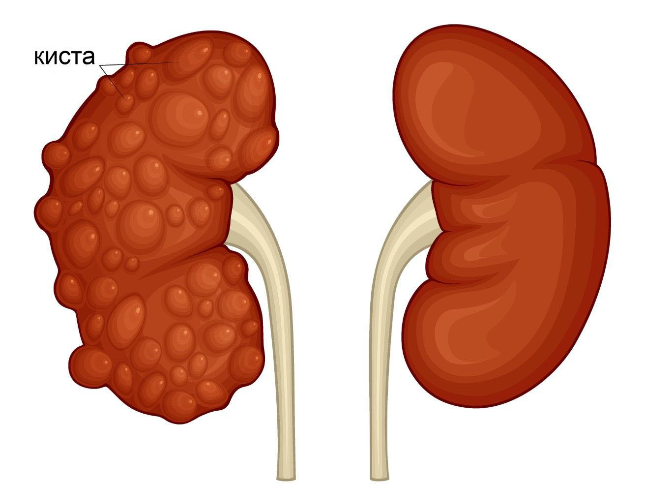 поликистоз почек