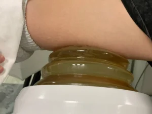 Литотрипсия