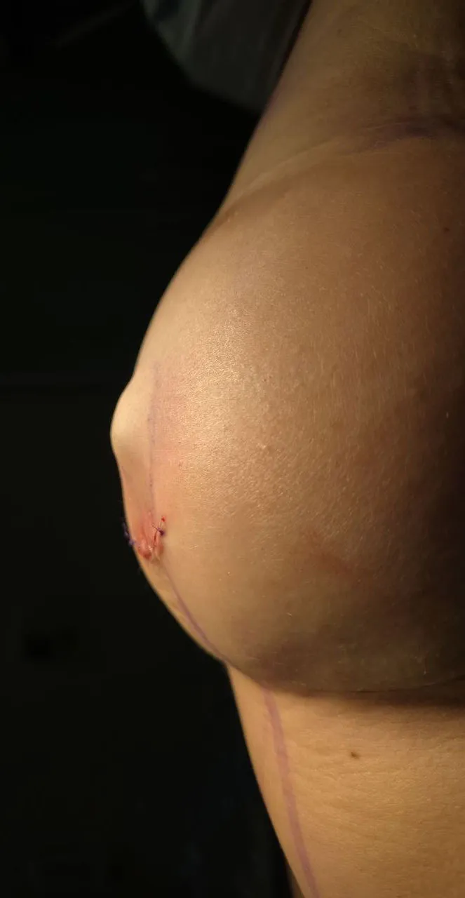 Грудь после операции