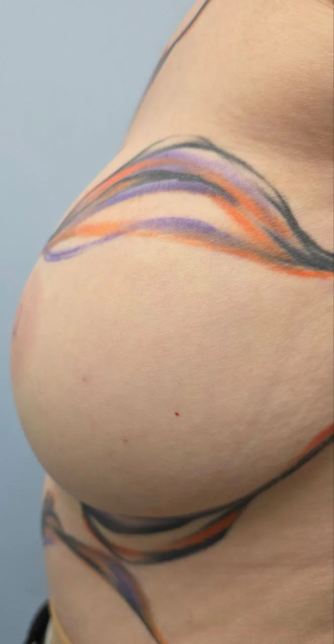 Грудь разметка до операции