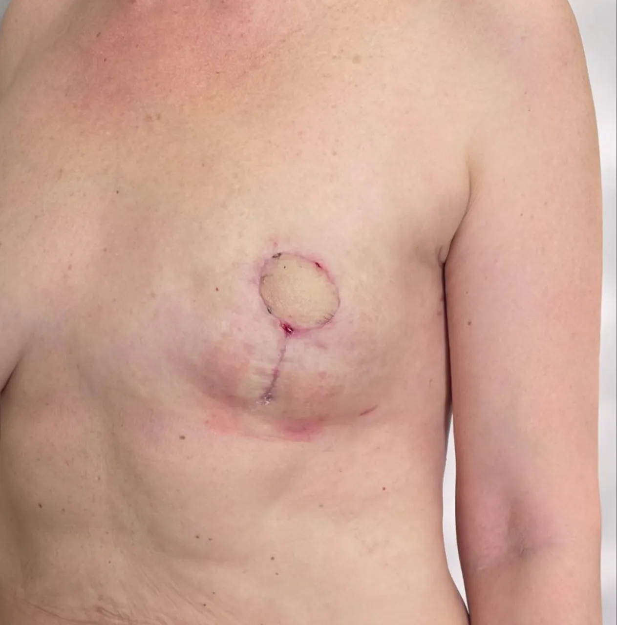 После операции PAP